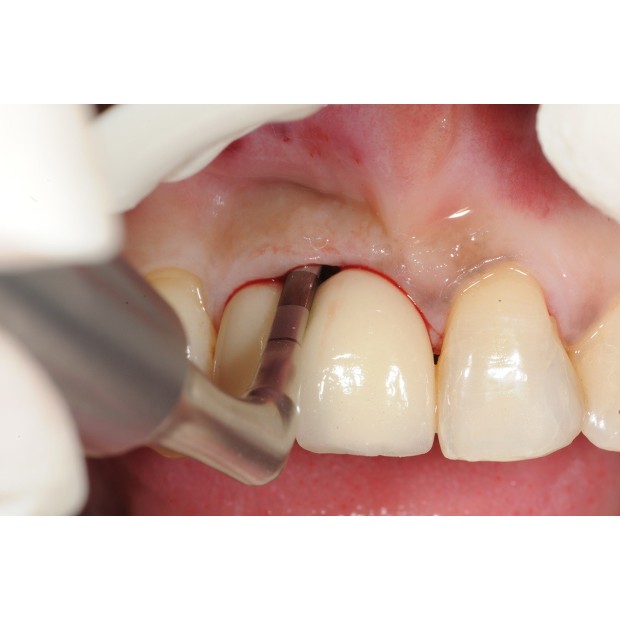 BUSE PERIO AIR-N-GO EASY