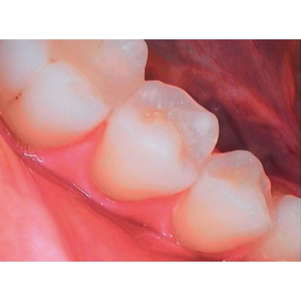 SOPRO 617 - CAMERA INTRA ORALE