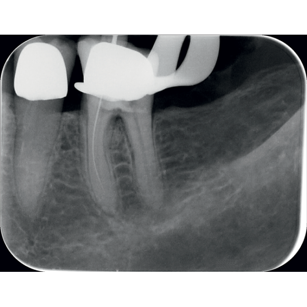 ECRAN A MEMOIRE ERLM TAILLE 2 STANDARD (x6)