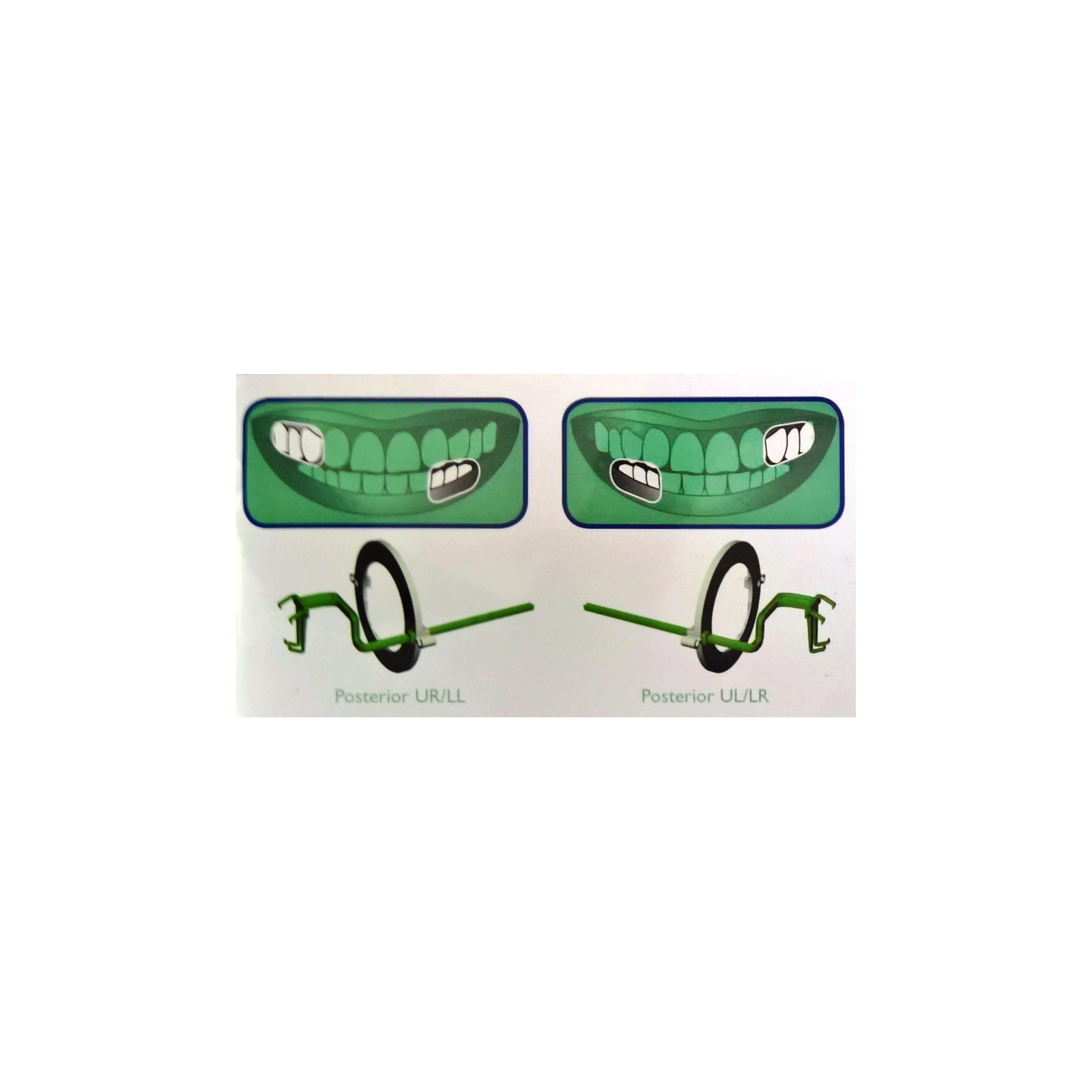 Kit de 10 angulateurs plastique Postérieur (vert) Taille 2