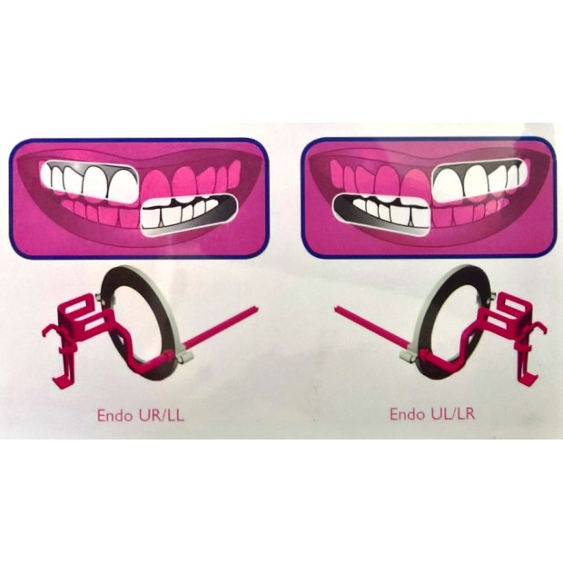 Kit de 6 angulateurs plastique Endo (rose) Taille 1